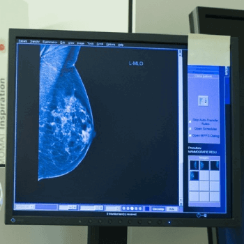 Computerscherm met een röntgenfoto van een borst