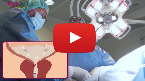 Beginbeeld van de voorlichtingsvideo over een operatie aan de prostaat via de plasbuis