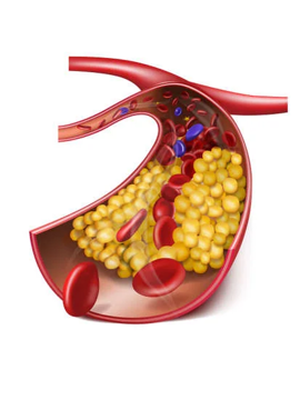 Hoog cholesterol 