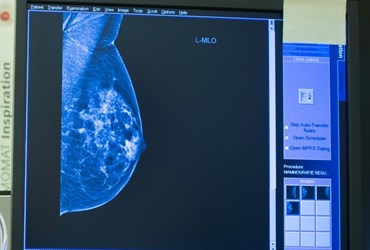 Computerscherm met een röntgenfoto van een borst