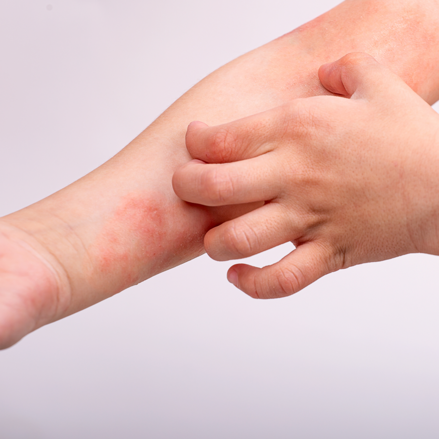 Kind krabt aan huid in elleboogplooi.