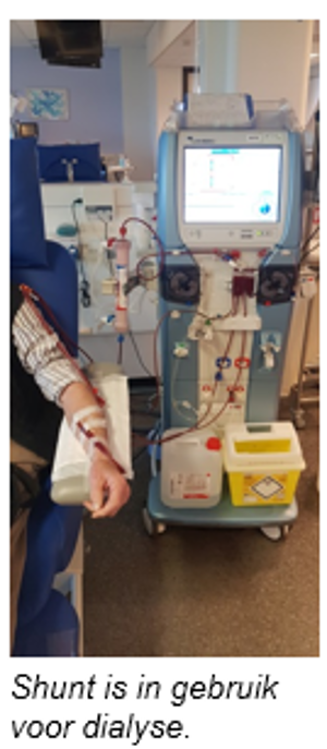 Op deze afbeelding ziet u een dialyse apparaat waarbij iemand zijn arm is aangekoppeld.