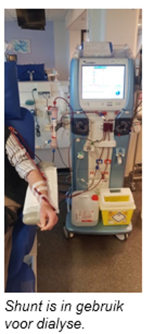 Op deze afbeelding ziet u een dialyse apparaat waarbij iemand zijn arm is aangekoppeld.