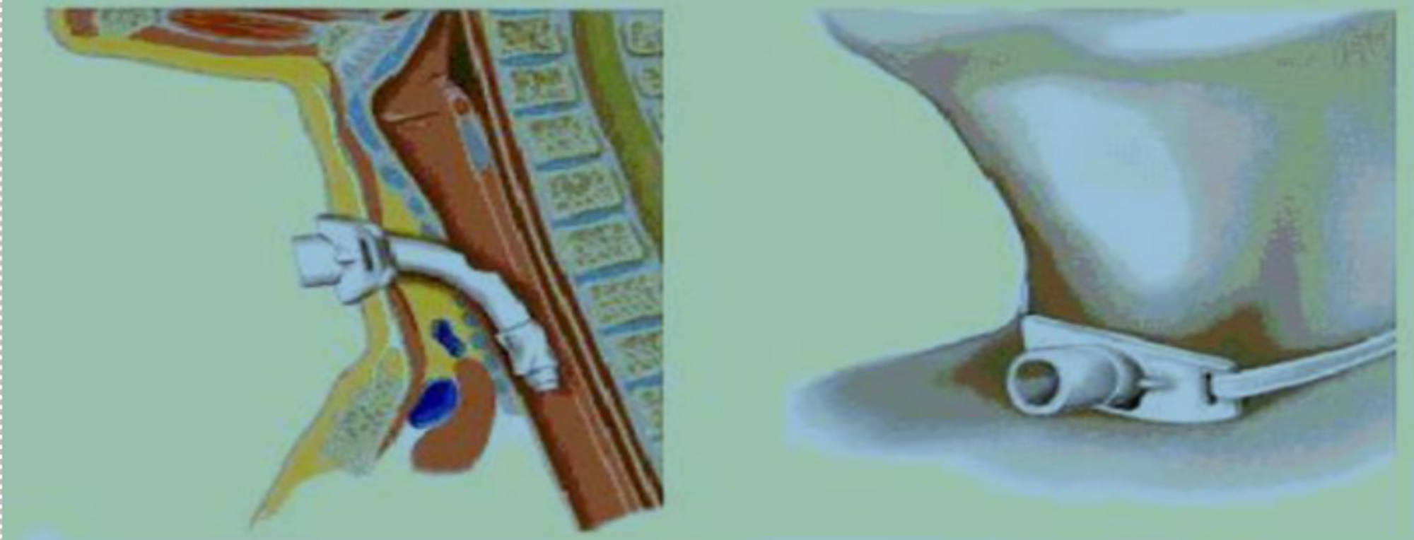tracheostoma 