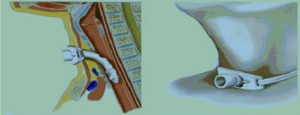 tracheostoma 