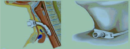 tracheostoma 