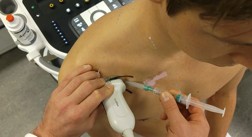 Figuur 2. Injectie in de kleine borst spier echogeleid. 