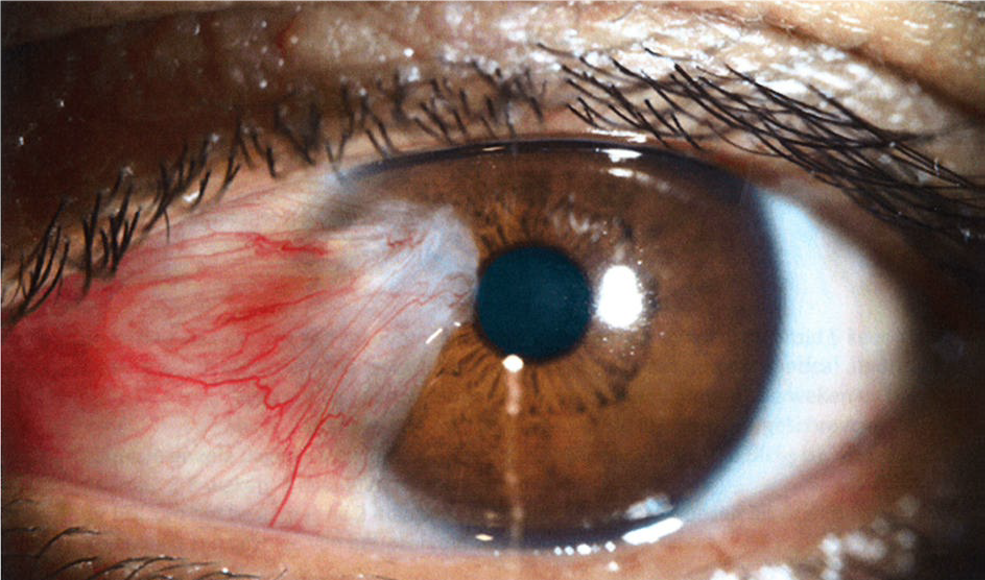 Pterygium/vleugelvlies