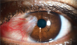 Pterygium/vleugelvlies Pterygium/vleugelvlies