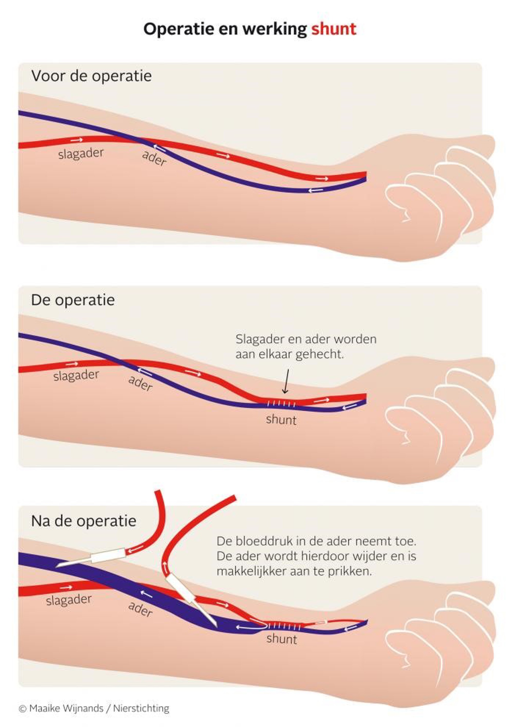 Op deze afbeelding ziet u 3 illustraties. Op de eerste illustratie laten ze zien hoe een ader en slagader in de arm liggen. Op de tweede illustratie laten ze zien dat tijdens de operatie de ader en slagader aan elkaar worden gehecht. Op de derde illustratie laten ze zien dat de bloeddruk na de operatie in de ader toeneemt waardoor de ader wijder wordt. Hierdoor is deze makkelijker aan te prikken. 
