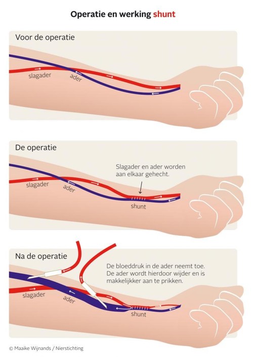 Op deze afbeelding ziet u 3 illustraties. Op de eerste illustratie laten ze zien hoe een ader en slagader in de arm liggen. Op de tweede illustratie laten ze zien dat tijdens de operatie de ader en slagader aan elkaar worden gehecht. Op de derde illustratie laten ze zien dat de bloeddruk na de operatie in de ader toeneemt waardoor de ader wijder wordt. Hierdoor is deze makkelijker aan te prikken. 