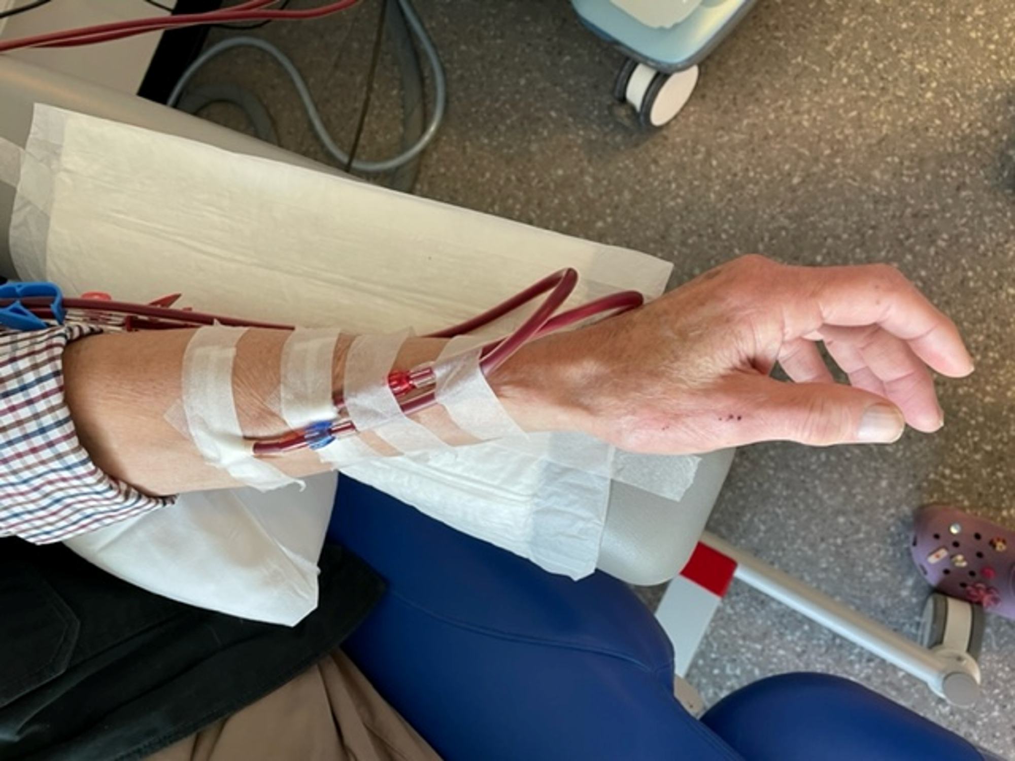 Op deze afbeelding is een onderarm te zien waarbij de shunt is aangeprikt en aan het dialyse apparaat is aangesloten.