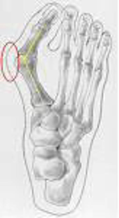 Hallux Valgus Hallux Valgus