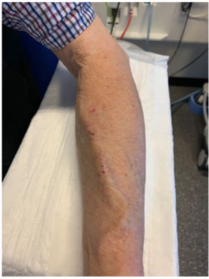 Op deze afbeelding is een onderarm te zien waarop duidelijk de ligging van de ader te zien is die nu als shunt dient. 